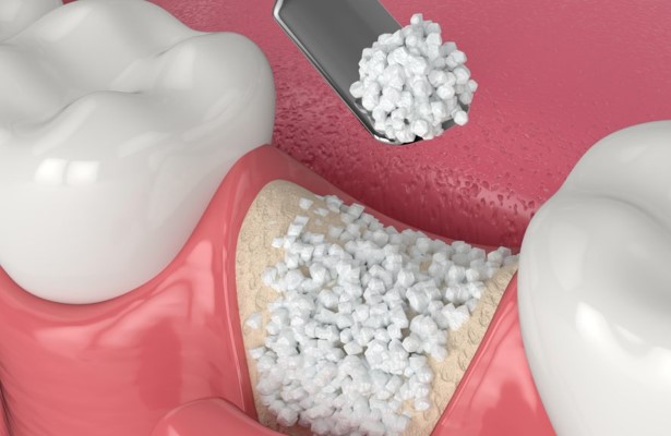 Augmentation-osseuse-et-PRF