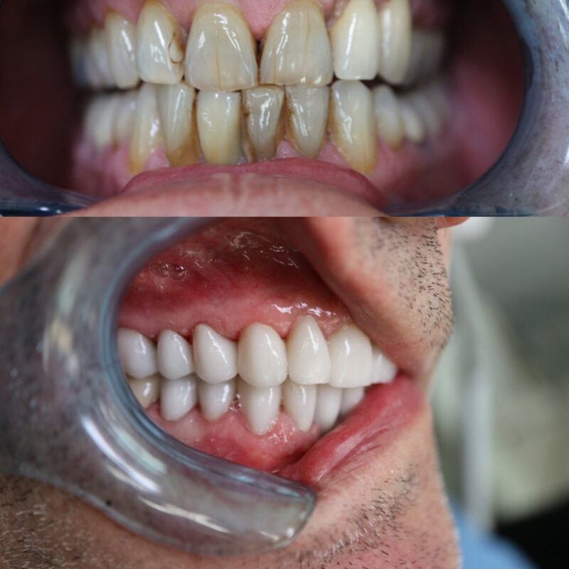 implants dentaires Aix-en-Provence Dr Zine Idrissi