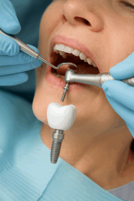 Pose d’un implant dentaire à Aix-en-Provence par le Dr Zine Idrissi, dentiste implantologue, utilisant les techniques de chirurgie guidée pour un résultat précis et indolore.