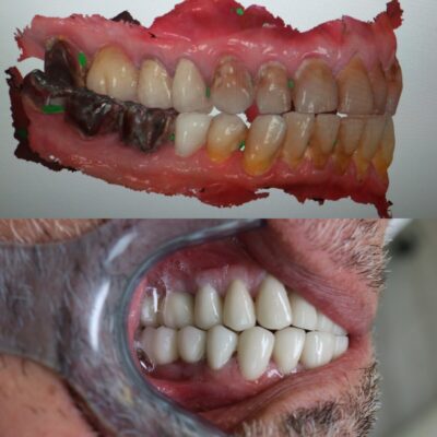 Gencives qui saignent : consultation chez le Dr Zine Idrissi, dentiste à Aix-en-Provence, spécialiste laser, ATP38 et analyse microscopique.