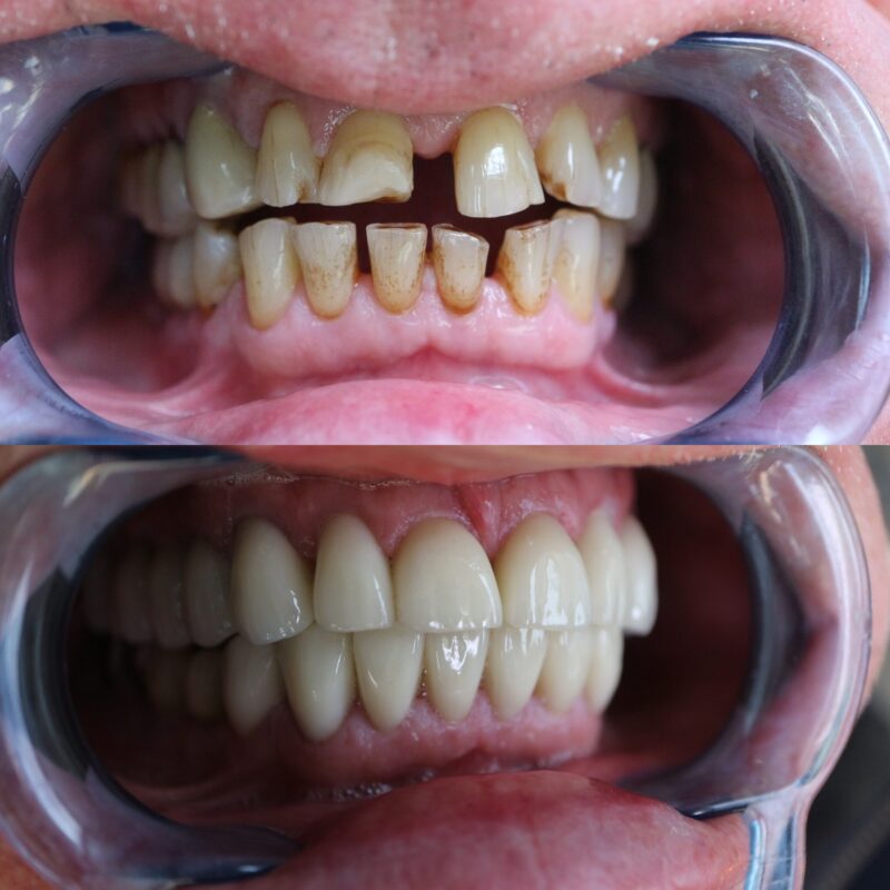 Consultation dentaire moderne avec le Dr Zine Idrissi, dentiste à Aix-en-Provence, pour remplacer des dents absentes avec un implant dentaire.