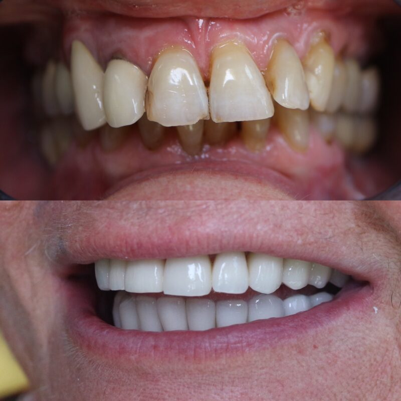 Avant après dentaire à Aix-en-Provence réalisé par le Dr Zine Idrissi