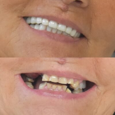 Réhabilitation dentaire complète avec Digital Smile Design à Aix-en-Provence – correction de l’usure dentaire et de la dimension verticale