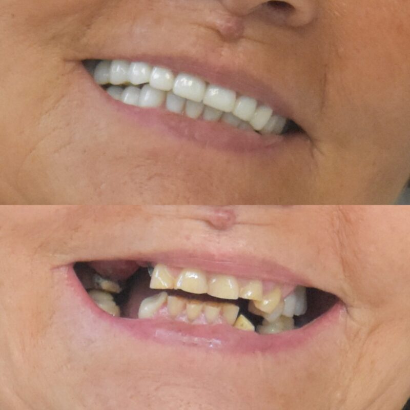 Réhabilitation dentaire complète avec Digital Smile Design à Aix-en-Provence – correction de l’usure dentaire et de la dimension verticale