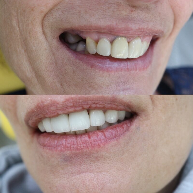 Réhabilitation complète par couronnes dentaires restaurant la dimension verticale d’occlusion à Aix-en-Provence