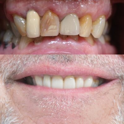 Traitement de l’usure dentaire avec Digital Smile Design et couronnes céramique EMAX au cabinet du Dr Zine Idrissi dentiste à Aix-en-Provence