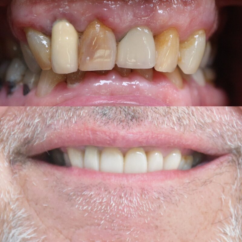 Traitement de l’usure dentaire avec Digital Smile Design et couronnes céramique EMAX au cabinet du Dr Zine Idrissi dentiste à Aix-en-Provence