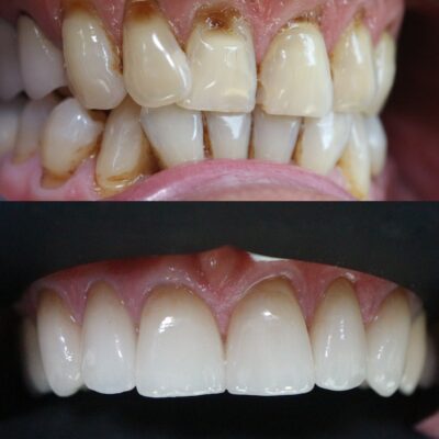 facettes 360 en céramique EMAX pour traiter l’usure dentaire à Aix-en-Provence